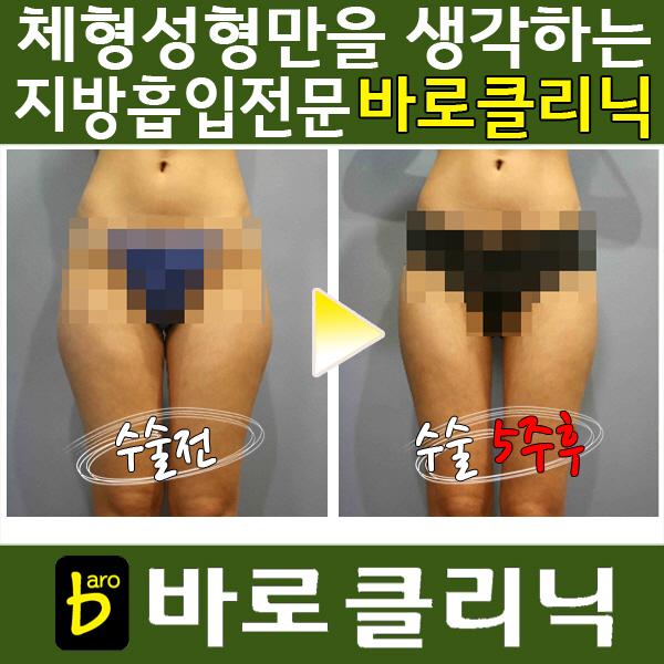 하체지방흡입,허벅지지방흡입 전문 바로클리닉