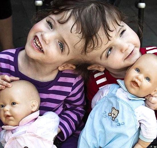 두개유합 샴쌍둥이(Craniopagus twins)