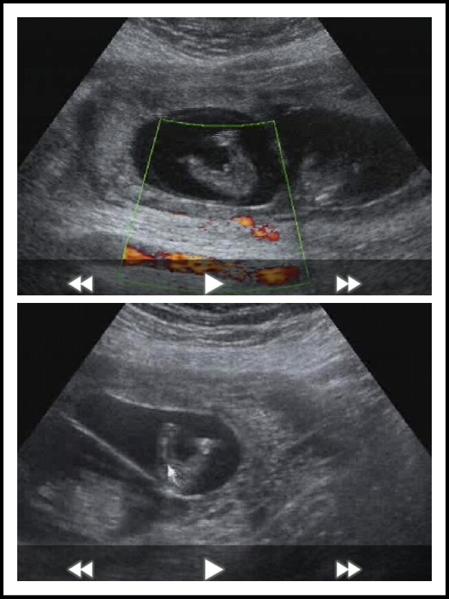 이란성쌍둥이 12주1일 성별 이란성쌍둥이 12주1일 성별