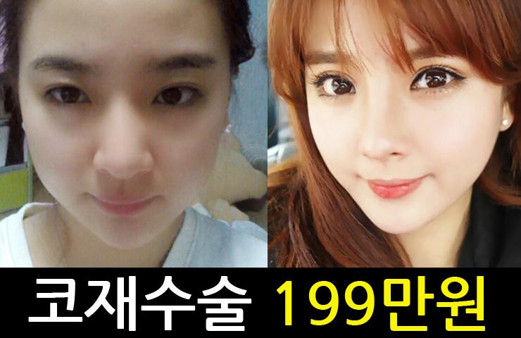 압구정안성형외과 코재수술가격 이벤트