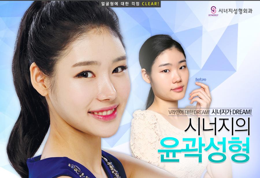 ★ 시너지성형외과 안면윤곽수술 후기 광대,사각턱 축소 ★